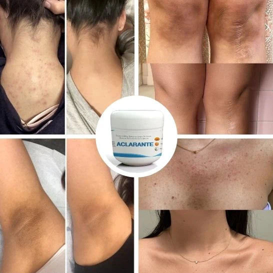 Crema Aclarante Despigmentante – Reduce Manchas, Melasma y Pecas
